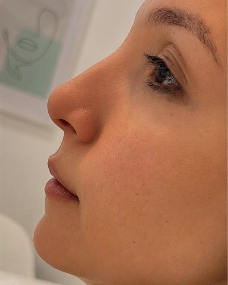 Perfil del rostro, antes y después: antes