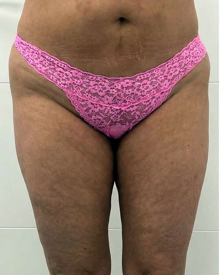 Piernas y abdomen, antes y después: antes
